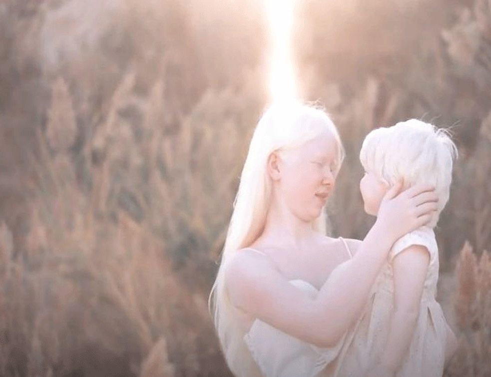 ALBINO LJUDI POSEBNI PO MNOGO ČEMU : Postali su meta lova zbog magijskih <span style='color:red;'><b>uverenja</b></span>