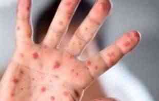 Epidemija malih boginja u Crnoj Gori: <span style='color:red;'><b>Zabrana ulaska</b></span> u vrtiće bez vakcinacije