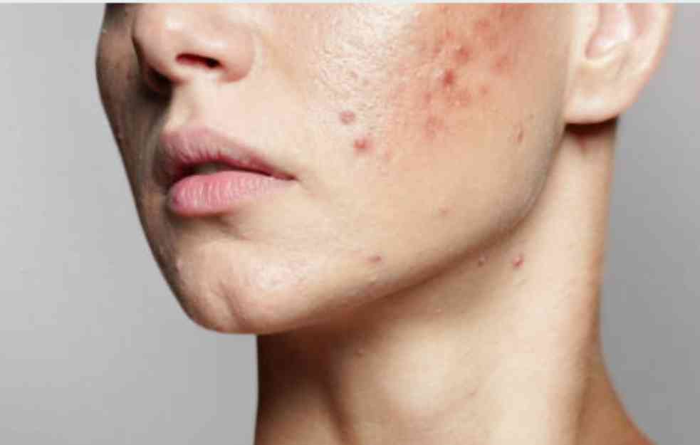 DERMATOLOG OTKRIVA KOJA JE NAJBOLJA HRANA U TRUDNOĆI : Kako biste sprečili pojavu akni