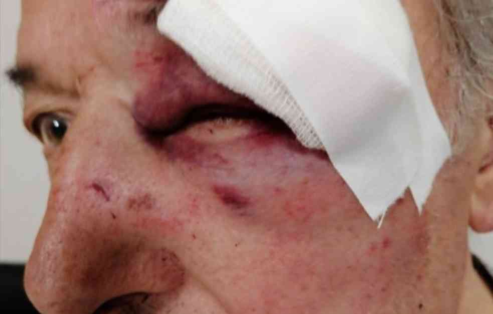UZNEMIRUJUĆE! U BEOGRADU PRETUČEN GENERAL U PENZIJI: Trojica nasilnika ga teško povredila na autobuskoj stanici! ZATVORILI MU OKO! (FOTO)