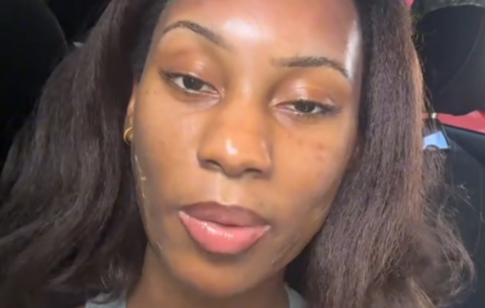 Zbog viralnog TikTok trenda dobila snažne opekotine