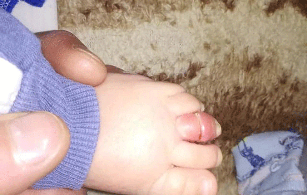 PORODICA IZ SOPOTA PREŽIVELA PAKAO: Tromesečnoj bebi se o<span style='color:red;'><b>bmo</b></span>tala dlaka oko prsta, i sa TEŠKIM POVREDAMA ZAVRŠILA U BOLNICI (FOTO) 