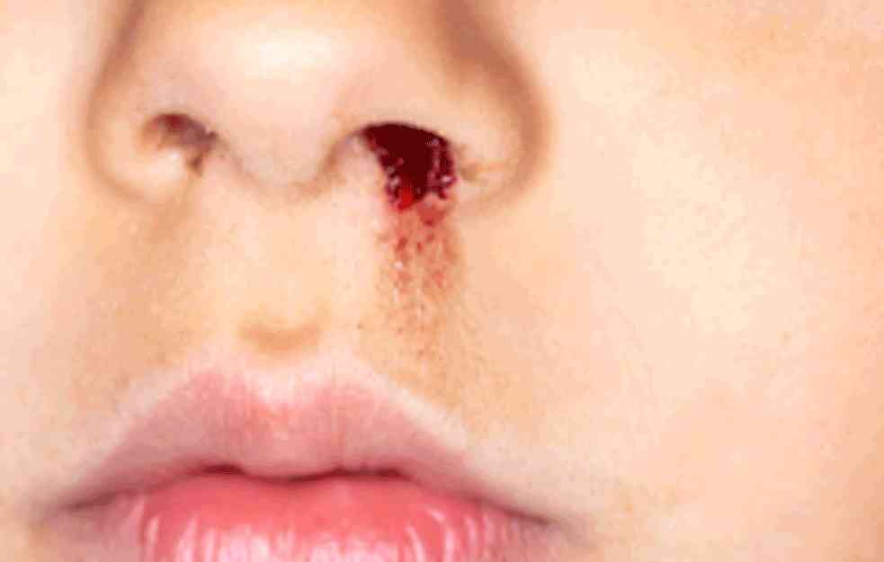 Mogući uzroci krvarenja iz nosa kod dece
