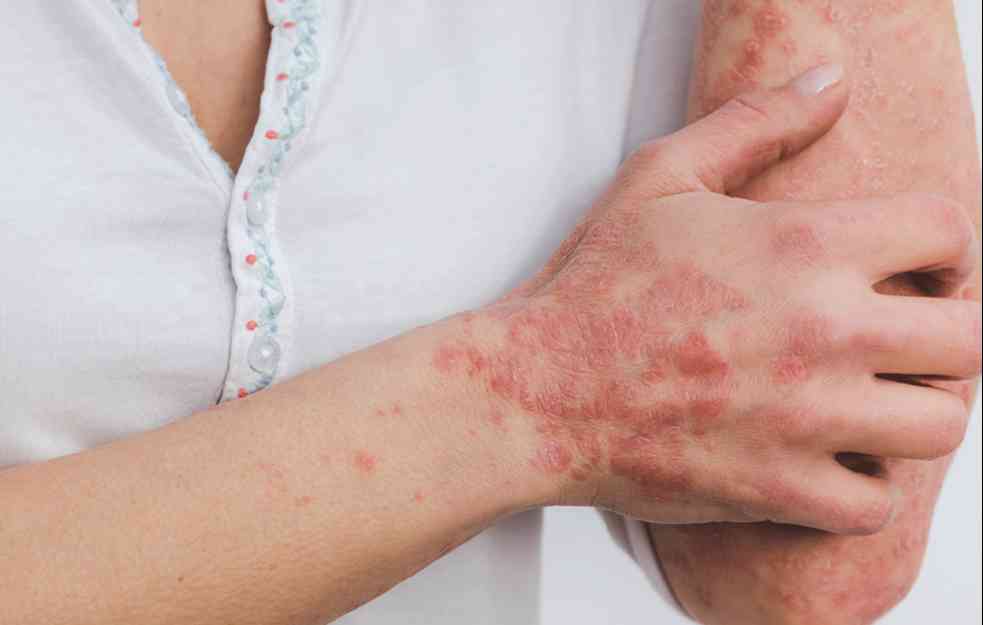 ISHRANOM DO LEPE I ZDRAVE KOŽE: Ove namirnice mogu doprineti ublažavanju uporne psorijaze