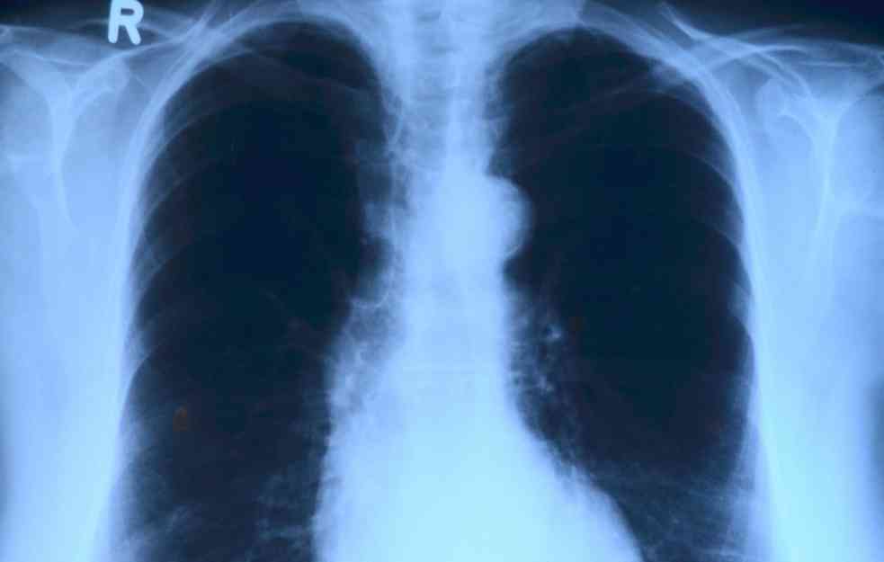 STUDIJA OTKRILA: Ovi pacijenti mogu imati SKRIVENA OŠTEĆENJA na plućima!
