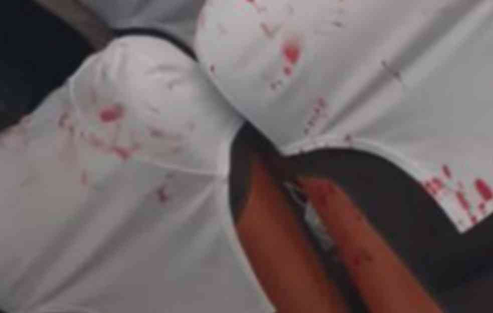 KRV NA SVE STRANE! Eksplozija u autobusu PUNOM FUDBALERA: Golmanu LICE UNAKAŽENO, igrači u bolnici (FOTO)