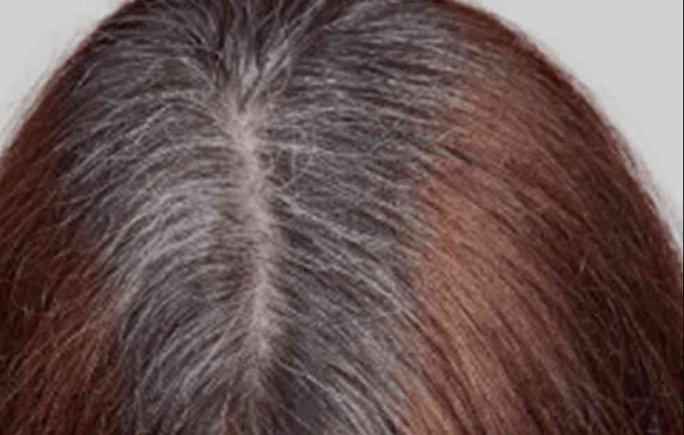 SIMPTOMI VISOKOG HOLESTEROLA: Dva znaka na kosi kazuju na problem, ko bi rekao da je to povezano? 