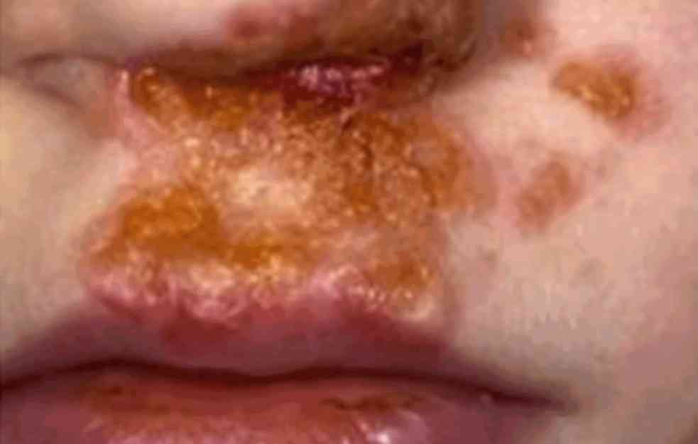 Impetigo kožna infekcija kod dece i njeno lečenje