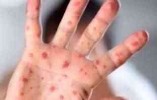 PANIKA U EVROPI: Širi se retka <span style='color:red;'><b>infektivna BOLEST</b></span>, svi strahuju od novog talasa EPIDEMIJE
