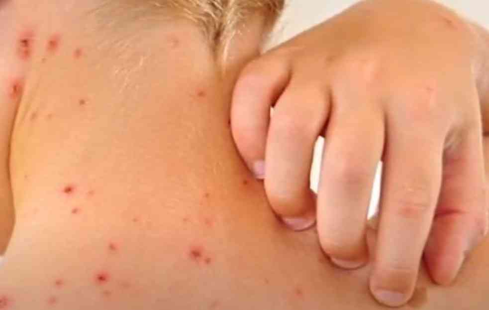 EPIDEMIJA JOŠ TRAJE: U Srbiji registrovano 68 slučajeva malih boginja