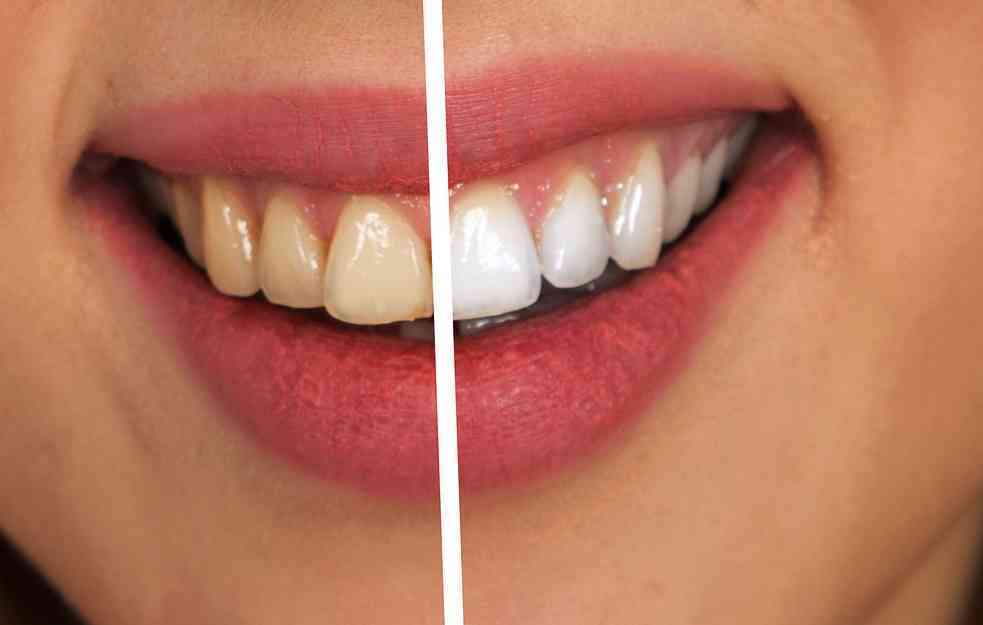 LOŠA HIGIJENA GLAVNI JE UZROK: Doktor otkriva šta boja zuba govori o našem zdravlju