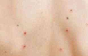 <span style='color:red;'><b>Epidemija</b></span> malih boginja širi se Amerikom: Troje mrtvih, među njima i dete!