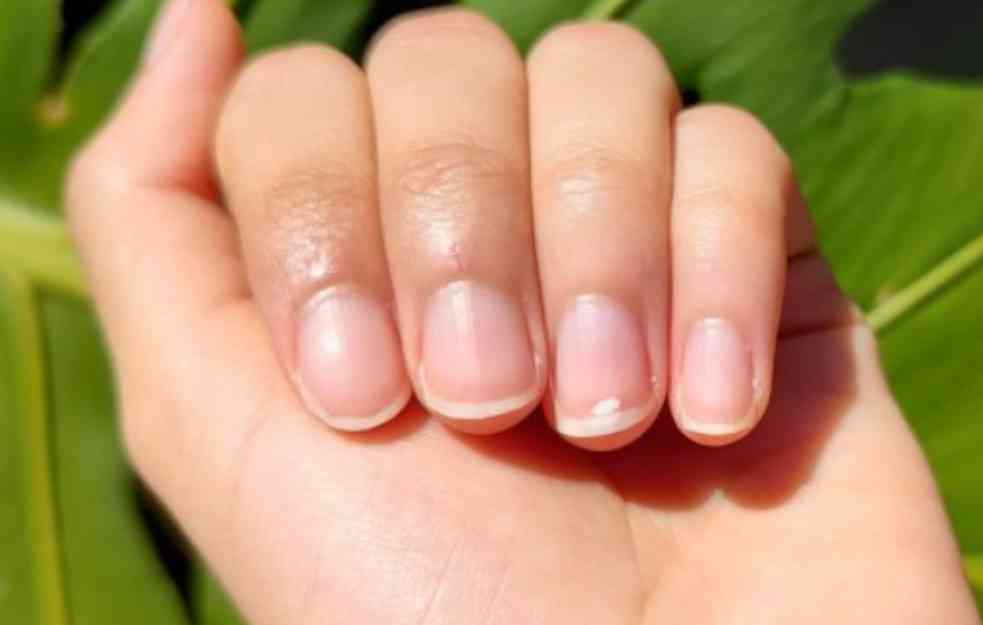 Šta znače BELE MRLJE na noktima: Ovo su mogući razlozi