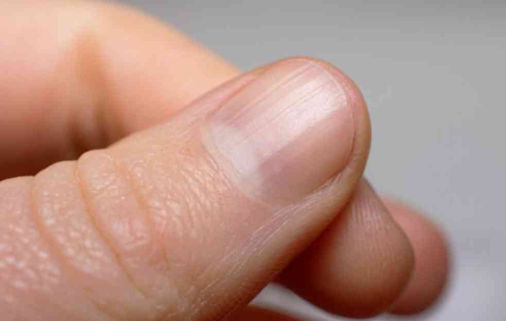 OBRATITE PAŽNJU: Ovi znakovi na koži i noktima ukazuju da imate povišen holesterol