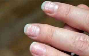 IAKO IZGLEDAJU BEZAZLENO, NE SMETE IGNORISATI: Bele mrlje na noktima mogu da predstavljaju simptom ozbiljnih bolesti