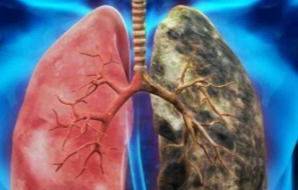 SZO upozorava: Rak pluća sve češći kod ljudi koji nikada nisu zapalili cigaretu