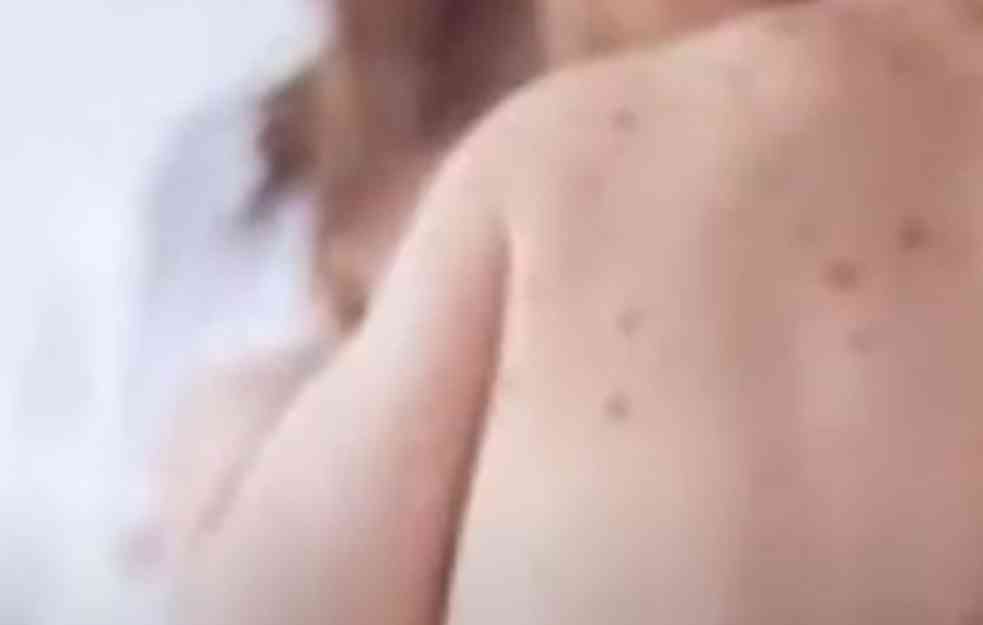  Raste broj inficiranih: U Teksasu prijavljeno 597 slučajeva malih boginja od kraja januara