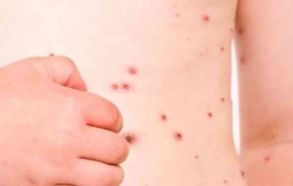 SZO: Broj slučajeva malih boginja u svetu prošle godine povećan za 20 odsto