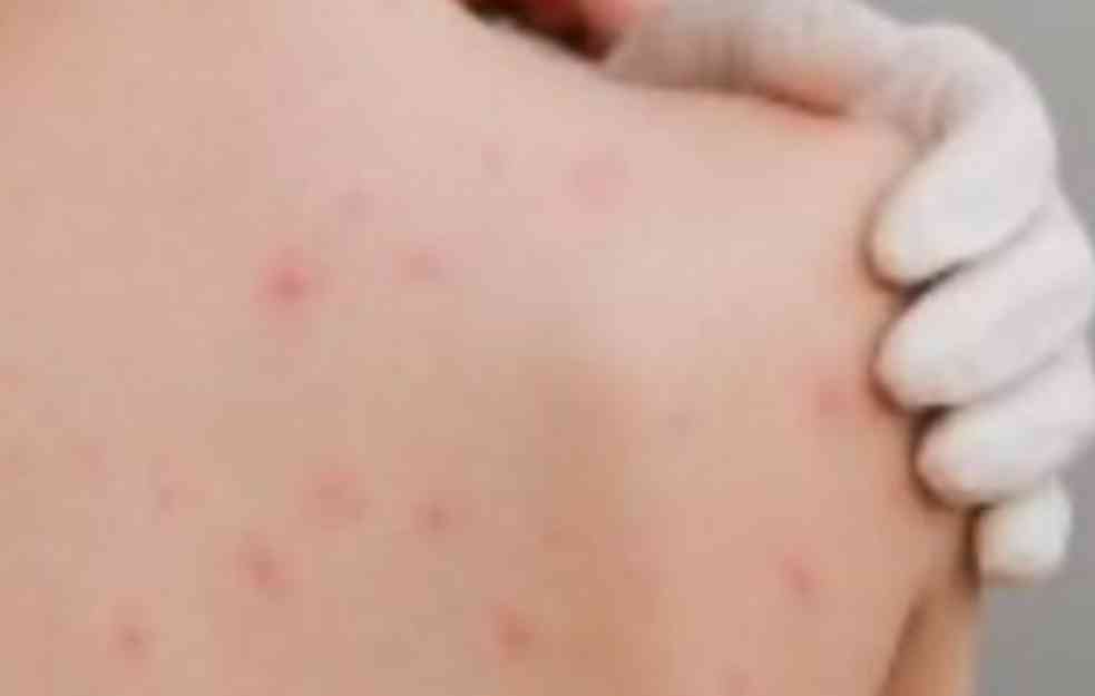 ŠIRI SE ZARAZA U SRBIJI: Ova četiri grada su na udaru