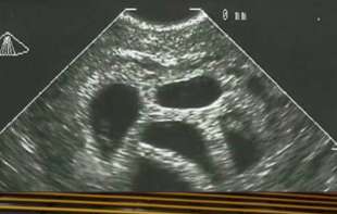 Doktor video petorke na ultrazvuku, savetovao majku na abortus: 20 godina kasnije objavila je