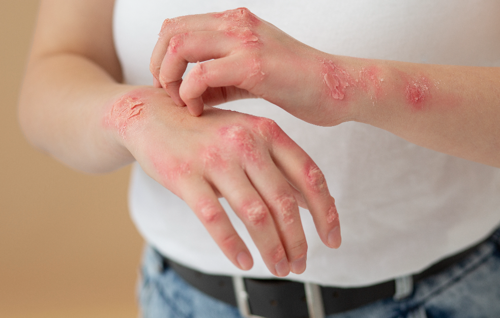 Svetski dan borbe protiv psorijaze: U Srbiji oko 140.000 obolelih